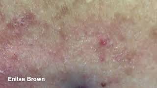 Christians Acne Back Treatment Blackheads Extractions [upl. by Korman205]