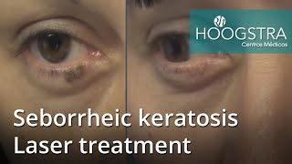 Seborrheic keratosis  Laser treatment 21021 [upl. by Artied116]