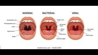 Pharyngitis Part 1 Viral Pharyngitis [upl. by Rebmaed]