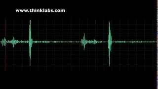 Aortic Insufficiency normal speed [upl. by Dhumma]