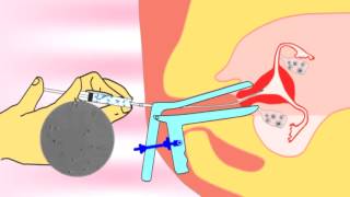 Intrauterine insemination IUI videoflv about infertility and ivf treatment [upl. by Klayman]