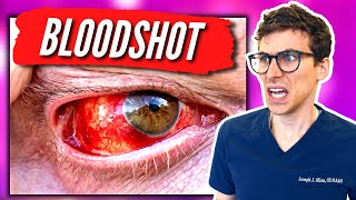 Bloodshot Eyes  What Causes Bloodshot Eyes and How to Get Rid of Them  Doctor Eye Health [upl. by Gonyea]