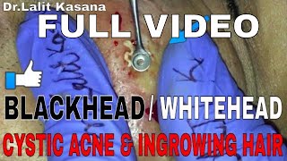 COMEDONES and CYSTIC ACNE POPPING FULL VIDEO 2 [upl. by Anurb556]