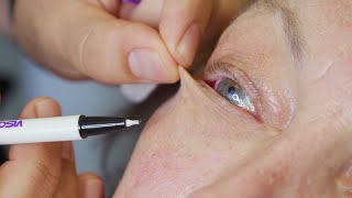 Ask the Eczperts How do you treat eyelid eczema [upl. by Acirahs]