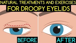 How to clean the eyelids for blepharitis treatment [upl. by Etteinotna]