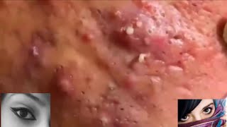 Severe Cystic Acne Infection Treatment Young Age [upl. by Dorrahs562]