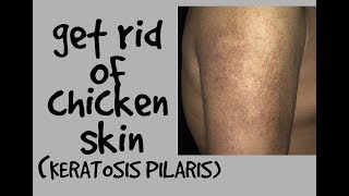 HOW TO GET RID OF CHICKEN SKIN KERATOSIS PILARIS DR DRAY [upl. by Titania]