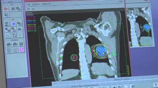 Radiation Therapy for Breast Cancer [upl. by Seys]