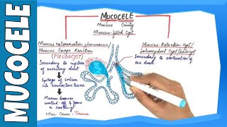 Mucocele  Types Clinical Features Histopathalogic features amp Treatment [upl. by Johst]