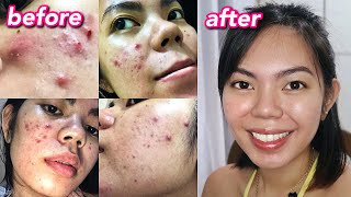 HOW I CLEARED MY ACNE  Cystic Hormonal Acne with PCOS Philippines [upl. by Vez]