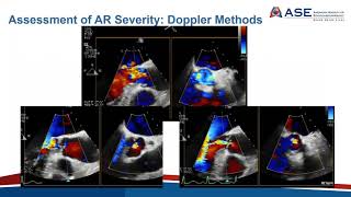 Aortic Regurgitation Insufficiency Explained Clearly [upl. by Romilda5]