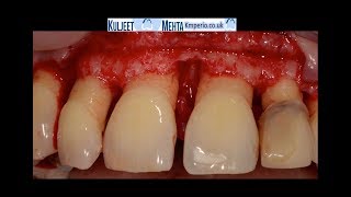 Periodontal Surgery Upper Front Teeth [upl. by Hait]