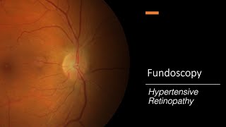 Hypertensive Retinopathy Fundoscopy [upl. by Saunders209]