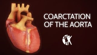 USMLE Step 1 Coarctation Of The Aorta [upl. by Anoyek]