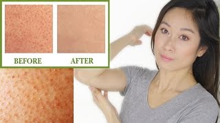 Keratosis Pilaris Treatment  Bumps On Skin quotChicken Skinquot  Vivienne Fung [upl. by Tyoh]