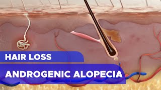 Hair Loss Androgenic Alopecia [upl. by Aliuqa183]