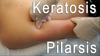 Keratosis Pilaris Clear  Brilliant Treatment FT Eric Smith  BLUSH Beverly Hills [upl. by Novla]