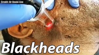 Worst Cystic Acne Biggest Blackheads and GIANT Cyst Removal [upl. by Aryt]