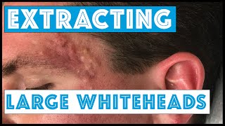 Acne Vulgaris and Extracting large Whiteheads  Part 1 [upl. by Lozar928]