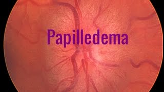 Papilledema A Swollen optic disc [upl. by Kermy]