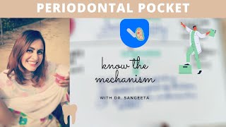 periodontal pocket carranza [upl. by Hunfredo]