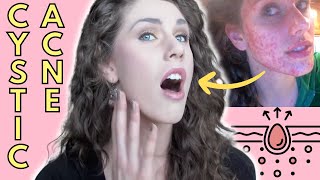 What Is Cystic Acne Causes Treatment  Cassandra Bankson [upl. by Ardaid]