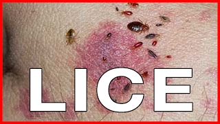 Pubic Lice or Crabs Info about Transmission Treatments Cure and Pictures [upl. by Eisserc189]