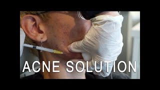 Cystic Acne Solution Kenalog Injection [upl. by Nedap]