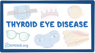 Thyroid Eye Disease causes symptoms diagnosis treatment pathology [upl. by Muriel984]