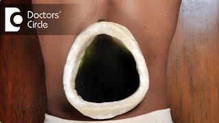 Ayurvedic treatment for Slip Disc  Dr Prashanth S Acharya [upl. by Lertram298]