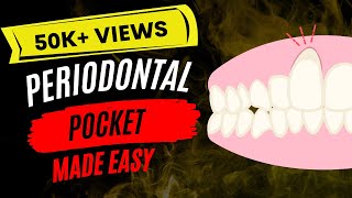 Periodontal disease  Periodontal pocket [upl. by Lindy]