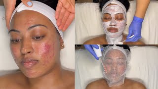 CYSTIC ACNE TREATMENT  WALKIN FACIAL FOR GRADE 3 AND 4 ACNE WITH PRO TIPS  LICENSED ESTHETICIAN [upl. by Erasmo]