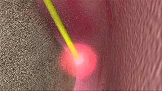 Laser Periodontal Therapy  WPT™ Animation [upl. by Goar]