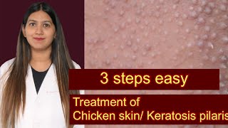 Keratosis pilaris treatment  chicken skin disease  bumps on upper arms  clogged pores treatment [upl. by Ragde230]