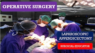 LAPAROSCOPIC APPENDICECTOMY STEP BY STEP Operative Surgery [upl. by Moran]