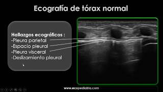 Ecografía de Derrame Pleural [upl. by Magavern]