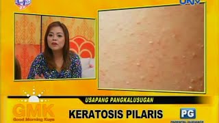 Keratosis Pilaris chicken skin [upl. by Htezzil88]