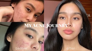 How I Cleared my Acne somehow PHILIPPINES  Lj Torres [upl. by Odey]