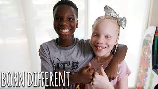 My Twin Sister Has Albinism  BORN DIFFERENT [upl. by Etireuqram]