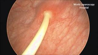 Removal of Double J stent by Cystoscopy [upl. by Salakcin]