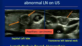 Cancer Treated with Radiation Therapy [upl. by Airot]