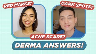 How to treat ACNE SCARS amp ACNE MARKS Dermatologist Answers Filipino  Jan Angelo [upl. by Ricker]