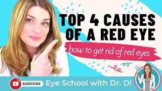 How To Get Rid Of Red Eyes  Top 4 Causes Of A Red Eye  An Optometrist Dishes all the Dirt [upl. by Eenafit421]