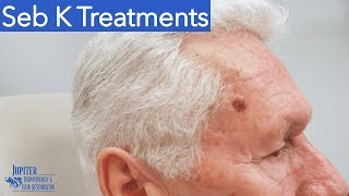 Seborrheic Keratosis Treatment amp Removal Liquid Nitrogen amp Curetagge [upl. by Kcinomod]