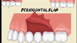 Periodontal Flap [upl. by Diana]