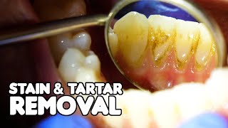 Dental Cleaning EXPLAINED  Stain amp Tartar Removal [upl. by Atteiluj]