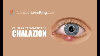 Chalazion  Causes Treatment and Surgery [upl. by Cheslie]