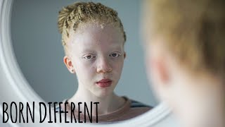 I’m Black Even With Albinism  BORN DIFFERENT [upl. by Weisbart]