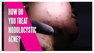 How Do You Treat Nodulocystic Acne  Houston Dermatology [upl. by Aneema492]