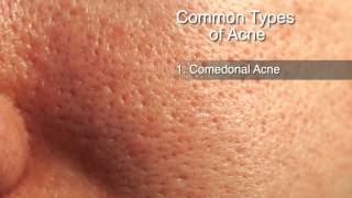 How to Treat Different Types of Acne [upl. by Nhguavoj]